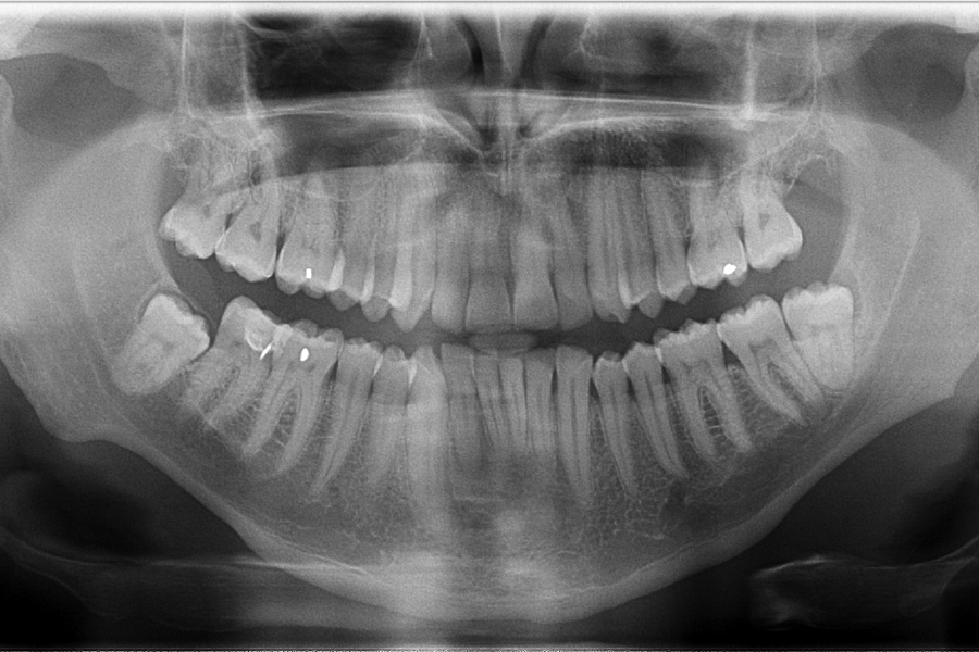 X-ray of a persons mouth.